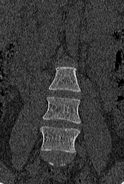 File:Normal CT lumbar spine (Radiopaedia 53981-60118 Coronal bone window 12).jpg