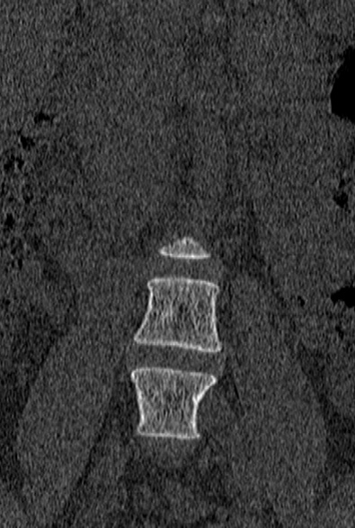 File:Normal CT lumbar spine (Radiopaedia 53981-60118 Coronal bone window 6).jpg