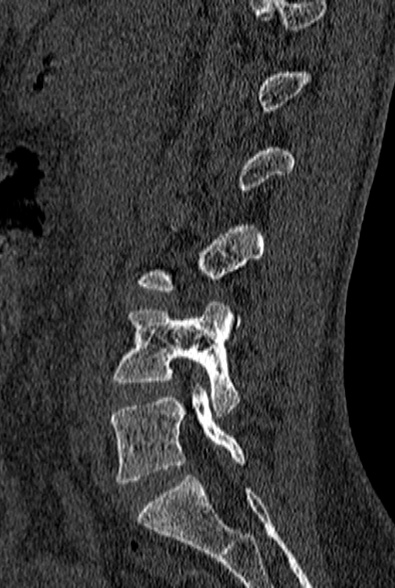 File:Normal CT lumbar spine (Radiopaedia 53981-60118 Sagittal bone window 33).jpg