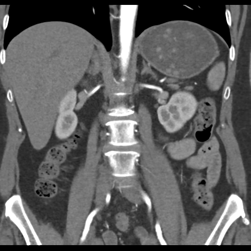 File:Normal CT renal artery angiogram (Radiopaedia 38727-40889 B 44).png
