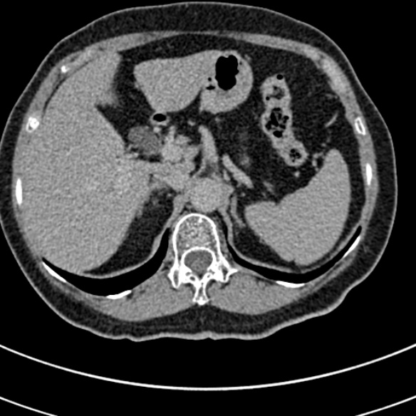 File:Normal CT split bolus study of the renal tract (Radiopaedia 48631-53634 Axial split bolus 16).jpg