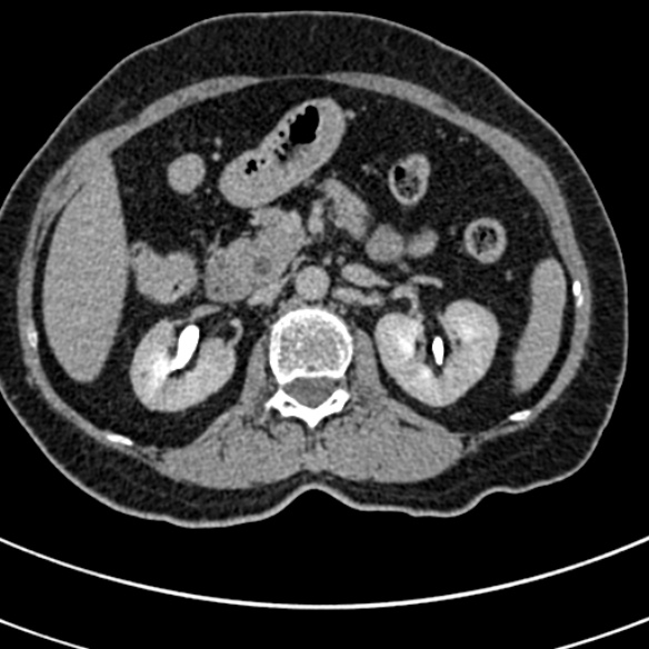 File:Normal CT split bolus study of the renal tract (Radiopaedia 48631-53634 Axial split bolus 63).jpg