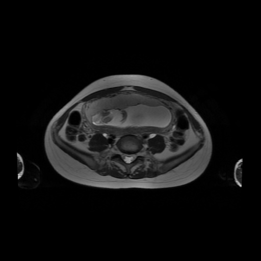 File:Normal MRI abdomen in pregnancy (Radiopaedia 88001-104541 Axial T2 45).jpg