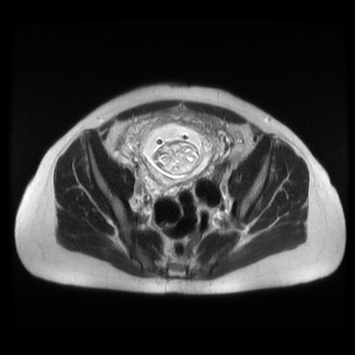 Normal MRI abdomen in pregnancy (Radiopaedia 88003-104546 Axial T2 38).jpg