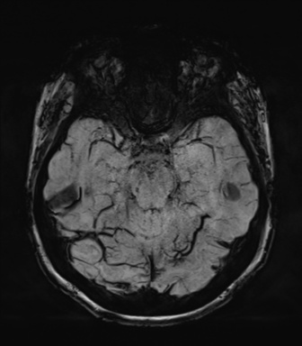 Normal MRI internal auditory canal (Radiopaedia 41613-44525 Axial SWI MIP 28).png