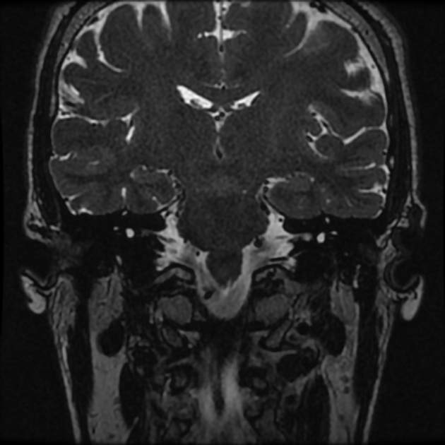Normal MRI petrous (Radiopaedia 91317-108949 Coronal T2 52).jpg