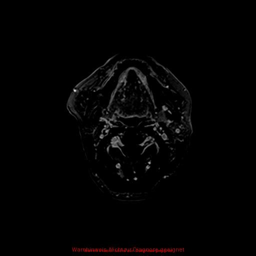 Normal adult brain MRI (non-enhanced and contrast-enhanced) (Radiopaedia 75262-86379 Axial T1 C+ 6).jpg