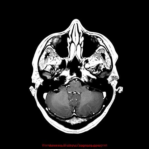 Normal adult brain MRI (non-enhanced and contrast-enhanced) (Radiopaedia 75262-86379 Axial T1 C+ 64).jpg
