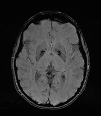 Normal brain MRI (TLE protocol) (Radiopaedia 40748-43405 Axial SWI 44).png
