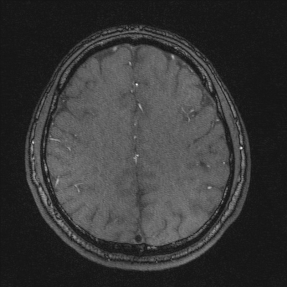 Normal brain MRI including MRA (Radiopaedia 48748-53763 Axial MRA 159).jpg