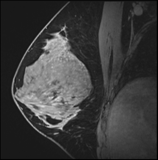 Normal breast MRI - dense breasts (Radiopaedia 80454-93850 I 85).jpg