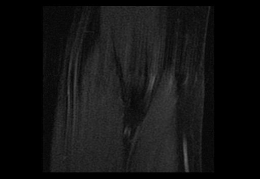 File:Normal elbow arthrograms (Radiopaedia 75550-86805 Coronal T1 fat sat 15).jpg