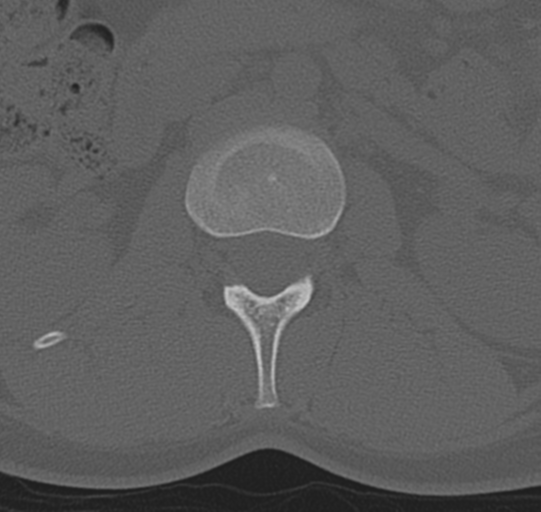 File:Normal lumbar spine CT (Radiopaedia 46533-50986 Axial bone window 15).png