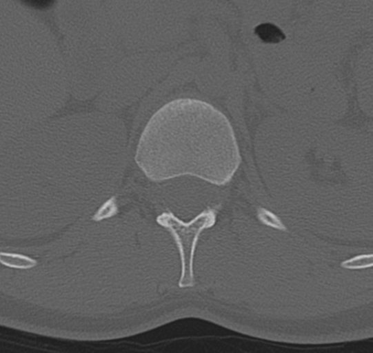 File:Normal lumbar spine CT (Radiopaedia 46533-50986 Axial bone window 3).png