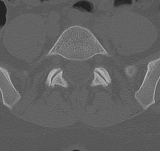 File:Normal lumbar spine CT (Radiopaedia 46533-50986 Axial bone window 61).png