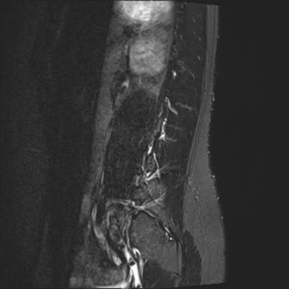 File:Normal lumbar spine MRI- 3 T (Radiopaedia 53280-59250 Sagittal STIR 22).jpg