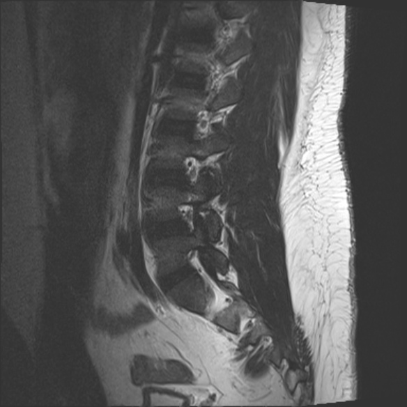 File:Normal lumbar spine MRI (Radiopaedia 47857-52609 Sagittal T2 5).jpg