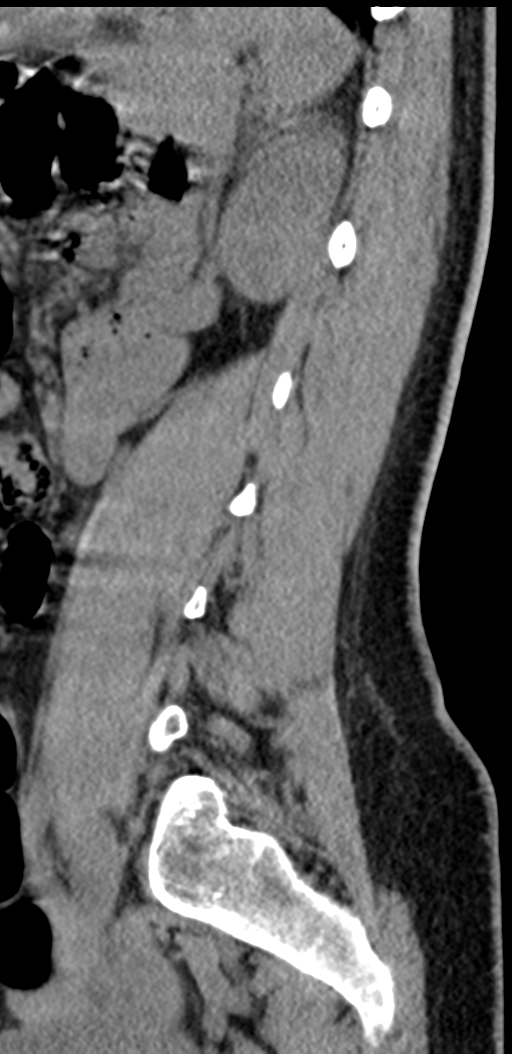 Normal lumbosacral CT (Radiopaedia 37923-39867 E 34).png