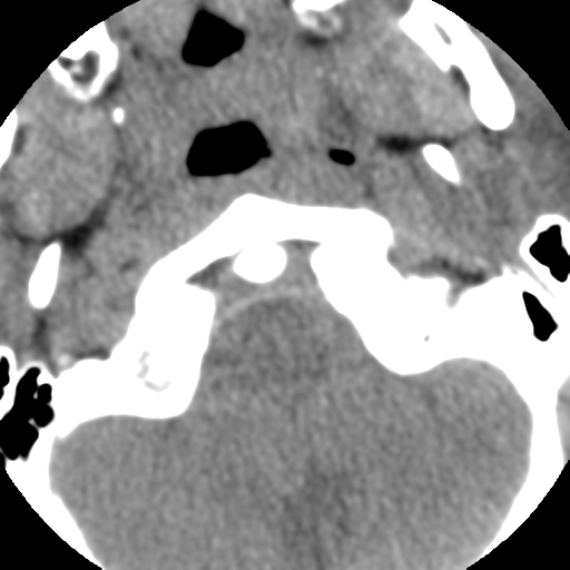 Normal trauma cervical spine (Radiopaedia 41017-43760 Axial non-contrast 10).png