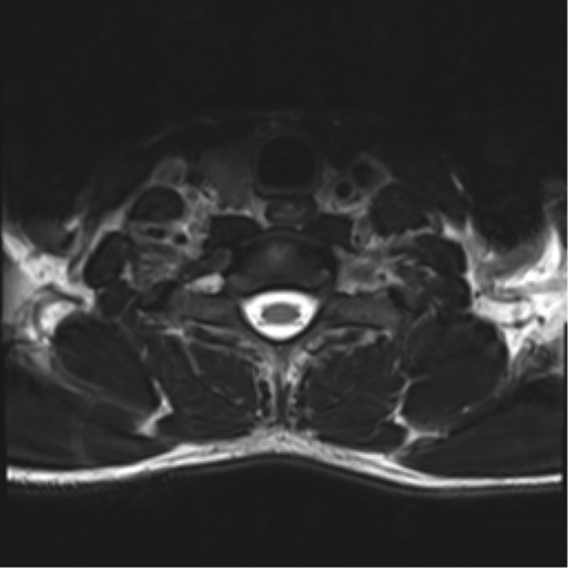 Normal trauma cervical spine (Radiopaedia 41017-43762 D 49).png