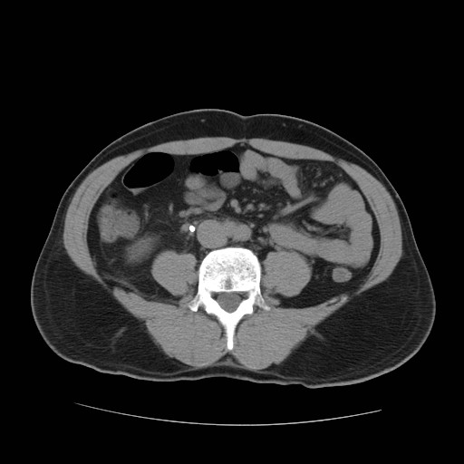 File:Obstructed kidney with perinephric urinoma (Radiopaedia 26889-27067 Axial non-contrast 24).jpg