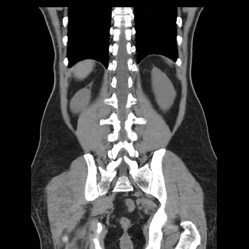 File:Obstructed kidney with perinephric urinoma (Radiopaedia 26889-27067 Coronal non-contrast 25).jpg