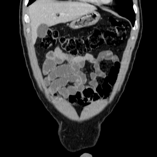 File:Obstructing ureteric calculus (Radiopaedia 18615-18514 C 14).jpg