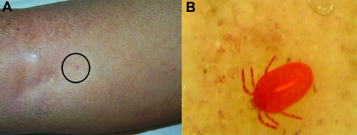 a) Clinical features and dermoscopy findings b) shows a Neotrombicula autumnalis mite attached to skin
