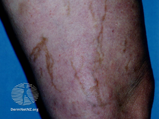 File:Post-sclerotherapy staining (DermNet NZ colour-haemo1).jpg