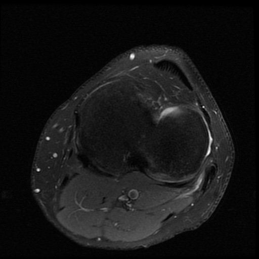 File:ACL and meniscal tears (Radiopaedia 79604-92797 Axial PD fat sat 18).jpg