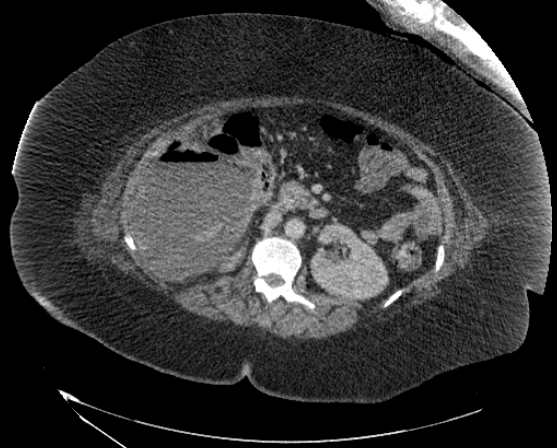 File:Abdominal abscess - pre and post percutaneous drainage (Radiopaedia 60209-67816 Axial 23).png