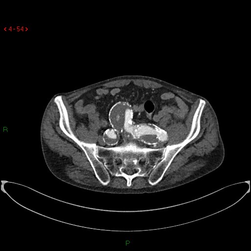 File:Abdominal aortic aneurysm (Radiopaedia 16155-15834 Axial C+ arterial phase 34).jpg