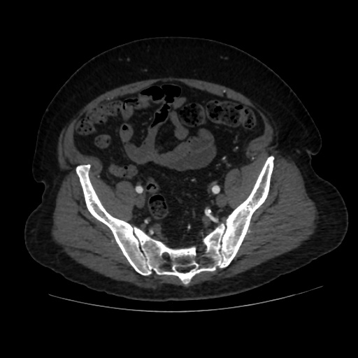 File:Abdominal aortic aneurysm (Radiopaedia 57318-64259 Axial C+ arterial phase 59).jpg