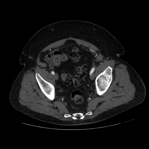 File:Abdominal aortic aneurysm (Radiopaedia 57318-64259 Axial C+ arterial phase 65).jpg