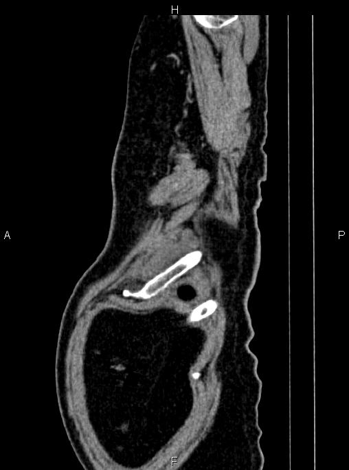 Abdominal aortic aneurysm (Radiopaedia 83094-97462 Sagittal renal cortical phase 119).jpg