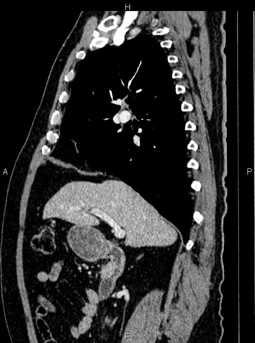 Abdominal aortic aneurysm (Radiopaedia 83094-97462 Sagittal renal cortical phase 49).jpg