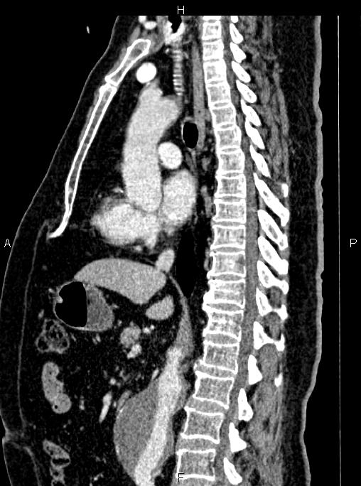 Abdominal aortic aneurysm (Radiopaedia 83094-97462 Sagittal renal cortical phase 64).jpg