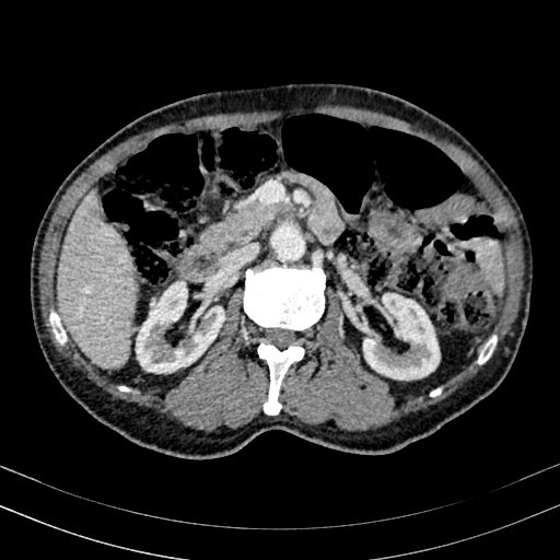 Abdominal aortic aneurysm (Radiopaedia 83581-98689 Axial C+ portal venous phase 47).jpg