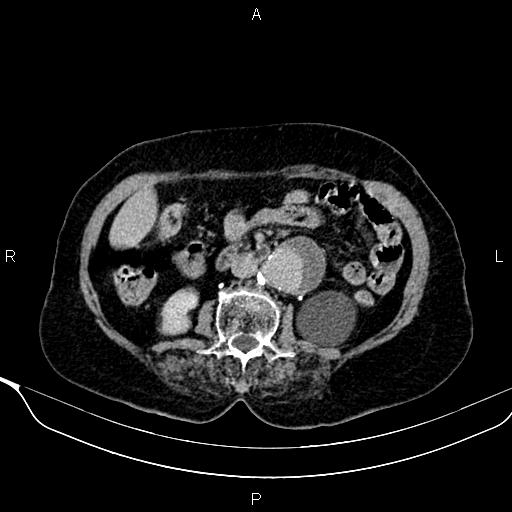 Abdominal aortic aneurysm (Radiopaedia 85063-100606 Axial C+ delayed 52).jpg