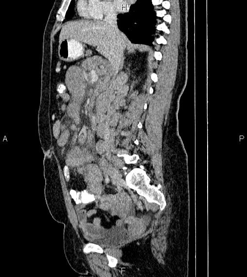 Abdominal lymphoma with sandwich sign (Radiopaedia 84378-99704 Sagittal C+ portal venous phase 38).jpg
