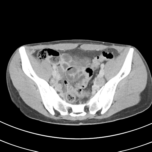 File:Abdominal multi-trauma - devascularised kidney and liver, spleen and pancreatic lacerations (Radiopaedia 34984-36486 Axial C+ delayed 64).png
