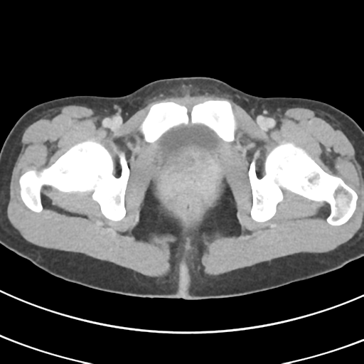 File:Abdominal multi-trauma - devascularised kidney and liver, spleen and pancreatic lacerations (Radiopaedia 34984-36486 Axial C+ delayed 80).png