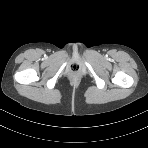 Abdominal multi-trauma - devascularised kidney and liver, spleen and pancreatic lacerations (Radiopaedia 34984-36486 Axial C+ portal venous phase 89).png