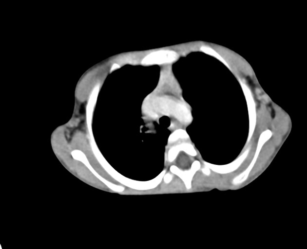 Abdominopelvic rhabdomyosarcoma (Radiopaedia 78356-90984 Axial C+ portal venous phase 11).jpg