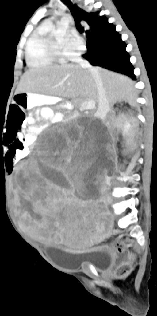 Abdominopelvic rhabdomyosarcoma (Radiopaedia 78356-90984 Sagittal C+ portal venous phase 52).jpg