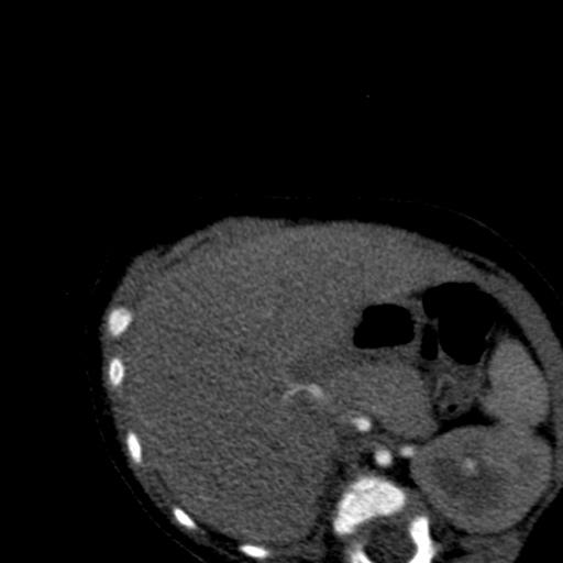 Aberrant left pulmonary artery (pulmonary sling) (Radiopaedia 42323-45435 Axial C+ CTPA 53).jpg