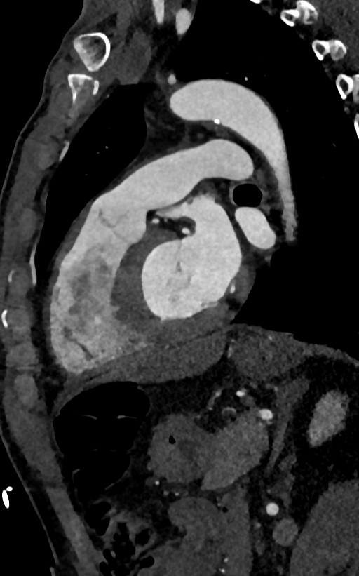 Accessory left atrial appendage (Radiopaedia 81987-95968 Sagittal C+ arterial phase 76).jpg