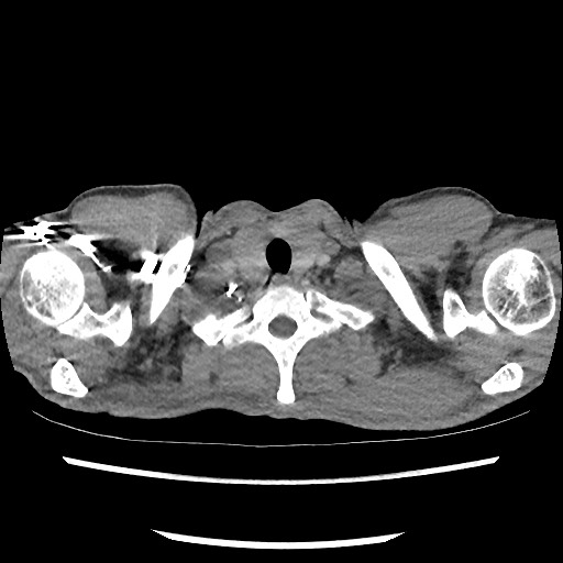 Accessory left horizontal fissure with lingular pneumonia (Radiopaedia 53763-59843 Axial C+ CTPA 5).jpg