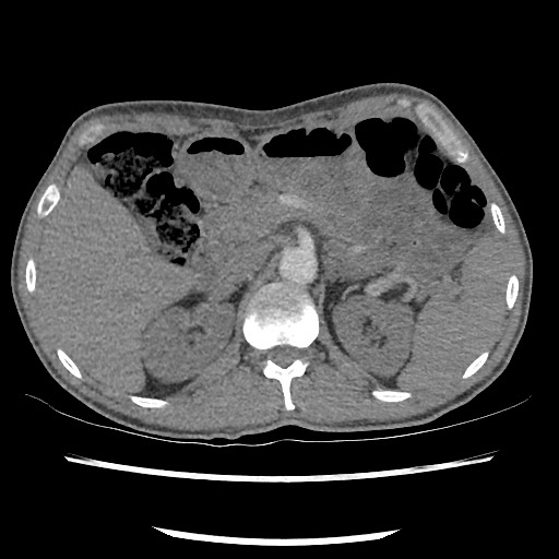 Accessory left horizontal fissure with lingular pneumonia (Radiopaedia 53763-59843 Axial C+ CTPA 97).jpg