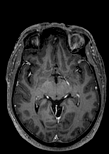 Accessory middle cerebral artery (Radiopaedia 73114-83828 Axial T1 C+ 56).jpg
